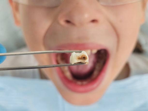 Best Emergency Dentist for Lost Fillings or Crowns in Emigsville, PA